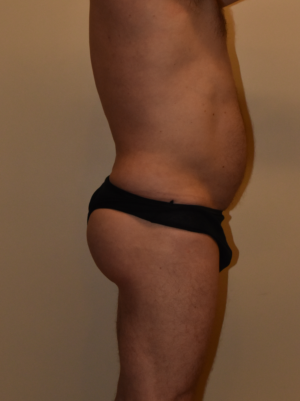 Buttock Augmentation Case 15974 After Photo Buttock Augmentation