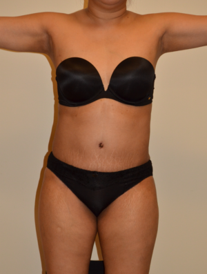 Liposuction Case 15975 After Photo Liposuction