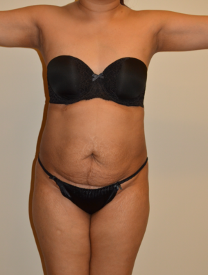 Liposuction Case 15975 Before Photo Liposuction