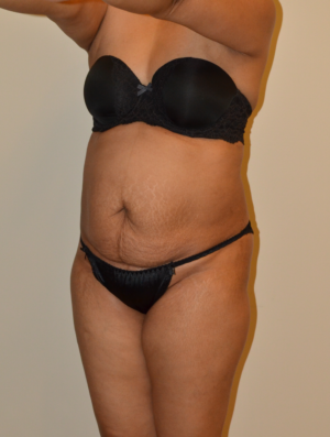 Liposuction Case 15975 Before Photo Liposuction