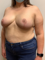 Breast Reduction