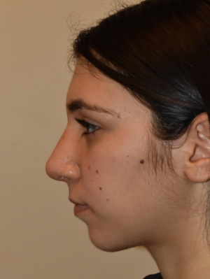 Nose Surgery Case 15943 After Photo Nose Surgery