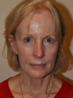 Facelift and Necklift