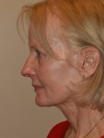 Facelift and Necklift