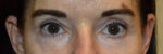 Eyelid Surgery