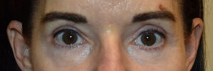 Eyelid Surgery Case 25024 After Photo Eyelid Surgery
