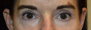 Eyelid Surgery