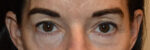 Eyelid Surgery