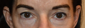 Eyelid Surgery Case 25024 Before Photo Eyelid Surgery