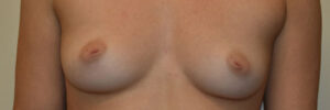 Inverted Nipple Repair Case 25040 Before Photo Inverted Nipple Repair