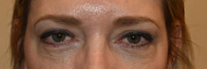 Eyelid Surgery Case 25075 After Photo Eyelid Surgery