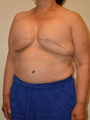 Breast Reconstruction