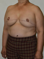 Breast Reconstruction