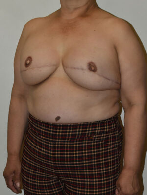 Breast Reconstruction Case 25097 After Photo Breast Reconstruction