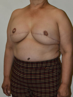 Breast Reconstruction