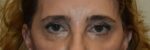 Brow Lift