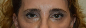 Eyelid Surgery