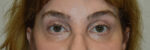 Brow Lift