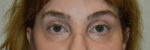 Eyelid Surgery