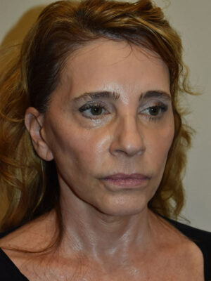 Facelift and Necklift Case 25110 Before Photo Facelift and Necklift