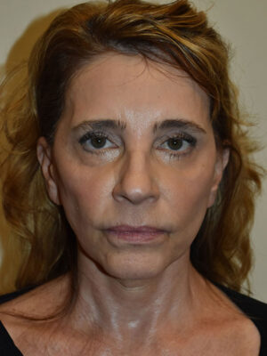 Facelift and Necklift Case 25110 Before Photo Facelift and Necklift