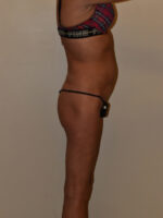 Buttock Augmentation