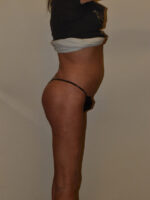 Buttock Augmentation
