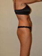 Buttock Augmentation
