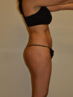 Buttock Augmentation