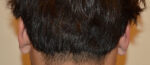 Otoplasty
