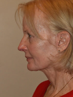 Facelift and Necklift Case 27232 After Photo Facelift and Necklift