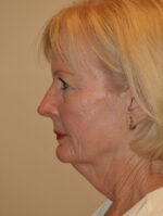 Facelift and Necklift