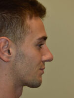 Nose Surgery