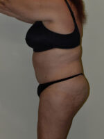 Tummy Tuck
