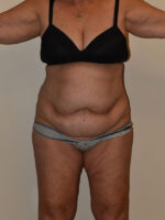 Tummy Tuck