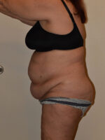 Tummy Tuck