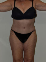 Tummy Tuck