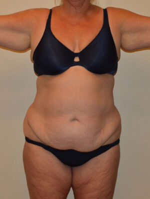 Tummy Tuck
