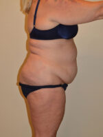 Tummy Tuck