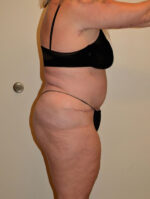 Tummy Tuck