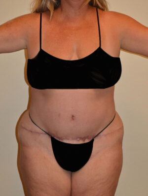 Tummy Tuck