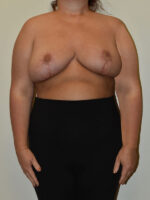 Breast Reduction