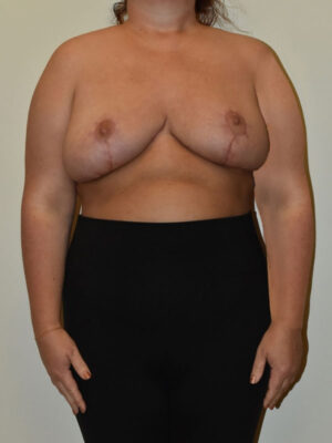 Breast Reduction Case 27256 After Photo Breast Reduction