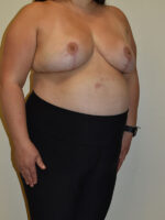 Breast Reduction