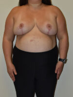 Breast Reduction
