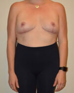 Breast Lift