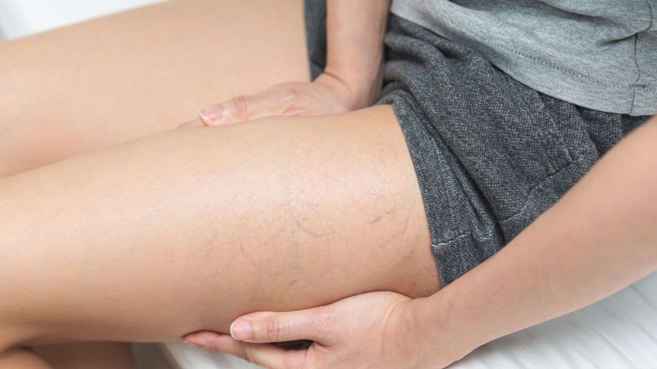 woman hand showing vascular, thrombosis on legs