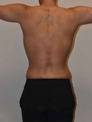 Liposuction Case 46235 After Photo Liposuction