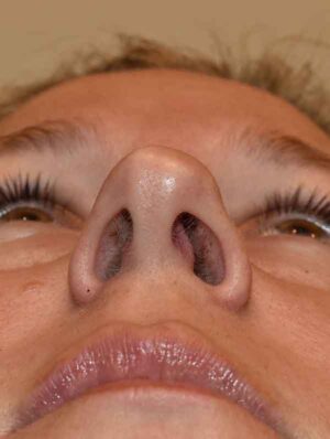Nose Surgery