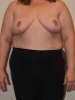 Breast Reduction
